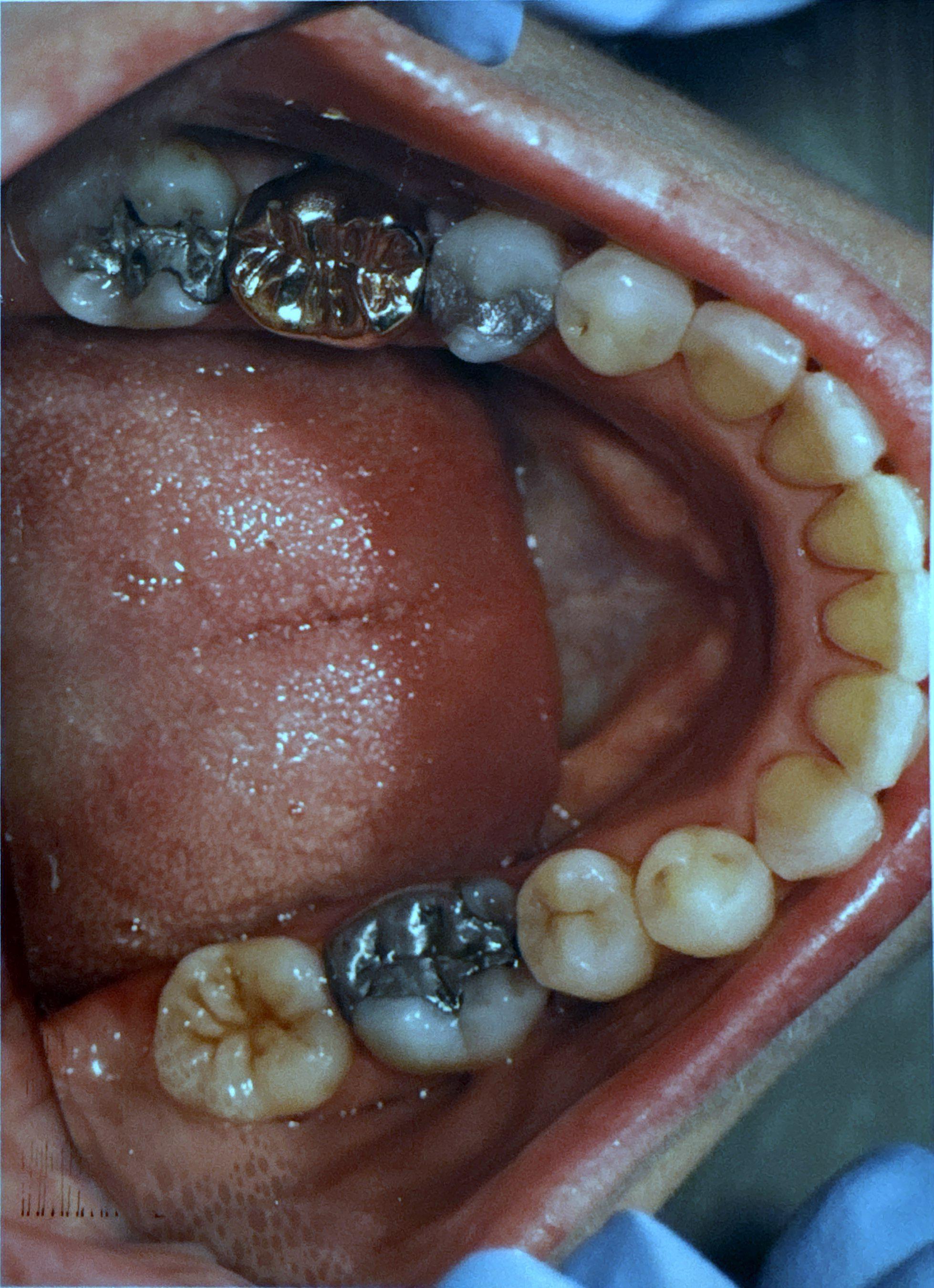 Smile after Invisalign treatment